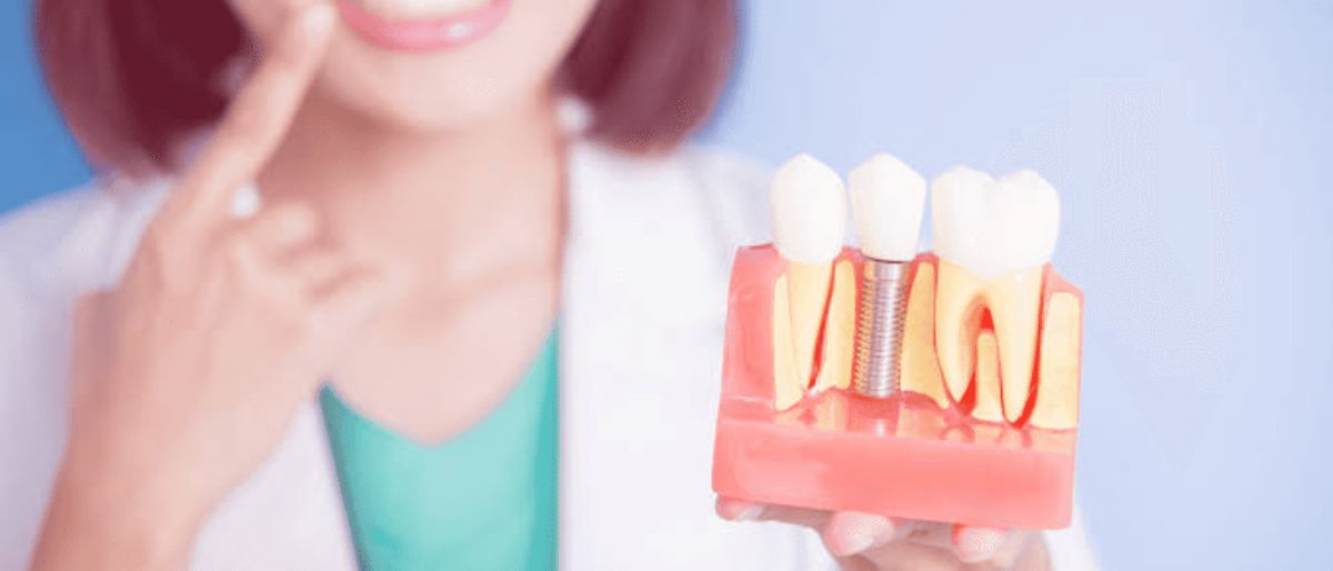 What Credit Score Do You Need To Finance Dental Implants