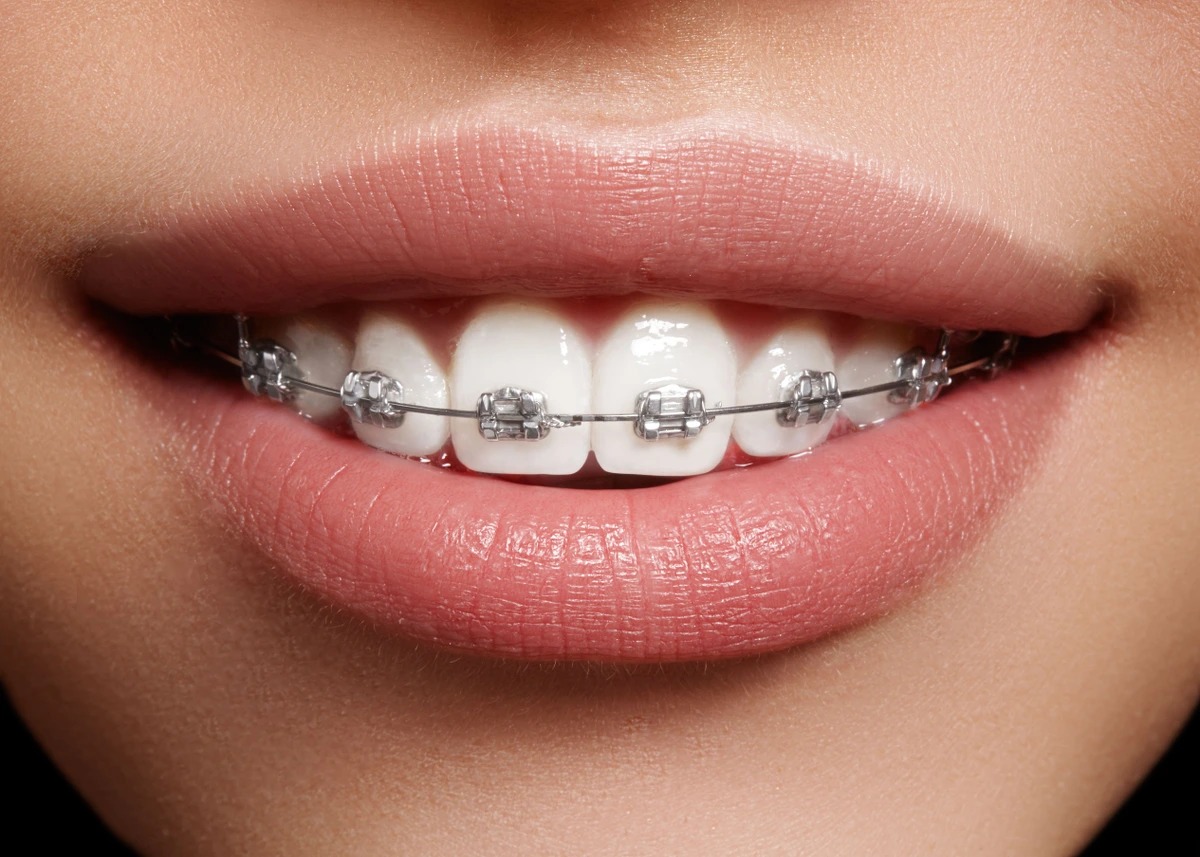 How Much Are Braces In California With Insurance?