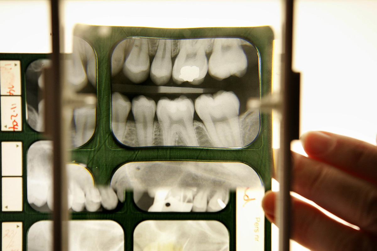 How Much Are Dental X-Rays Without Insurance?