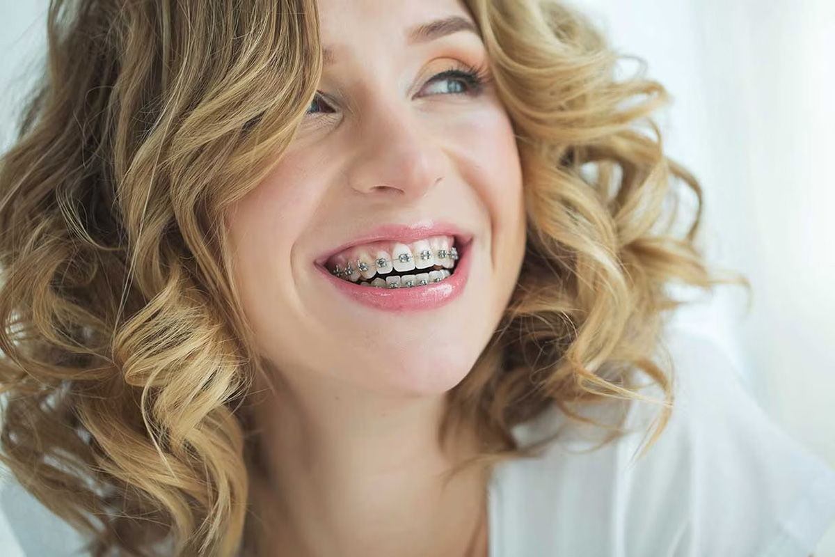 How Much Do Braces Cost For Adults Without Insurance?