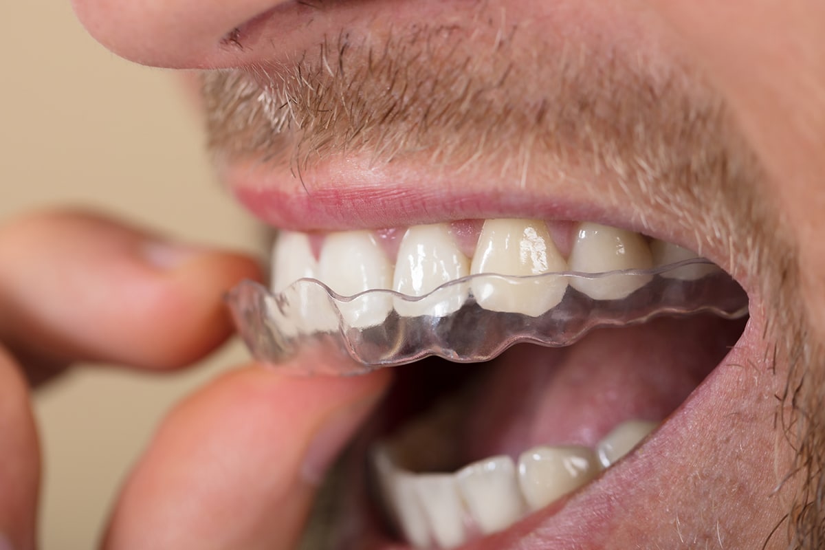 How Much Does Insurance Cover For Invisalign?
