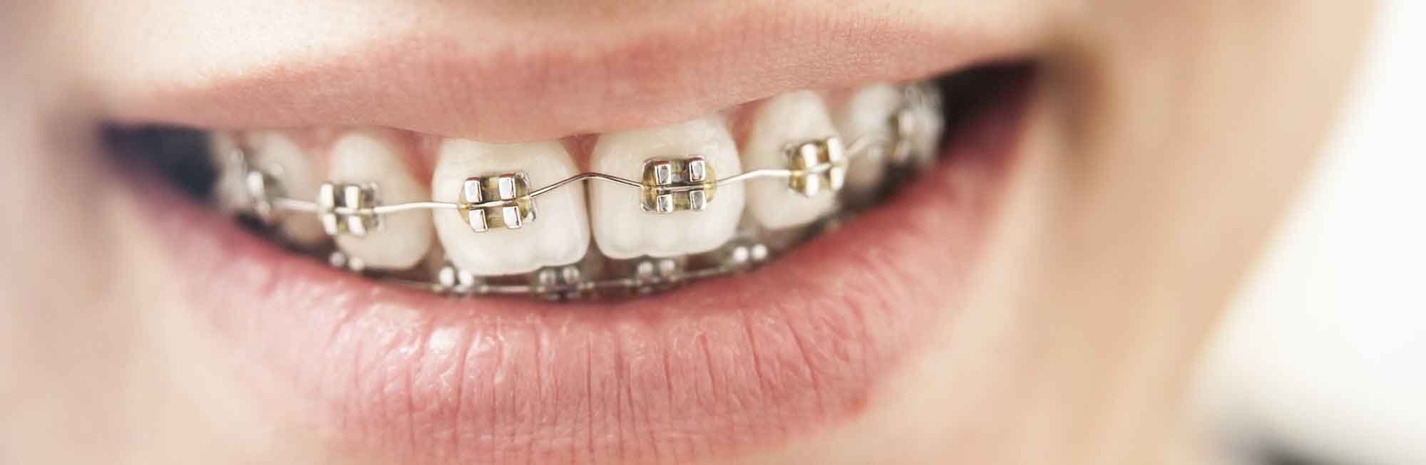 How Much Does Insurance Pay For Braces