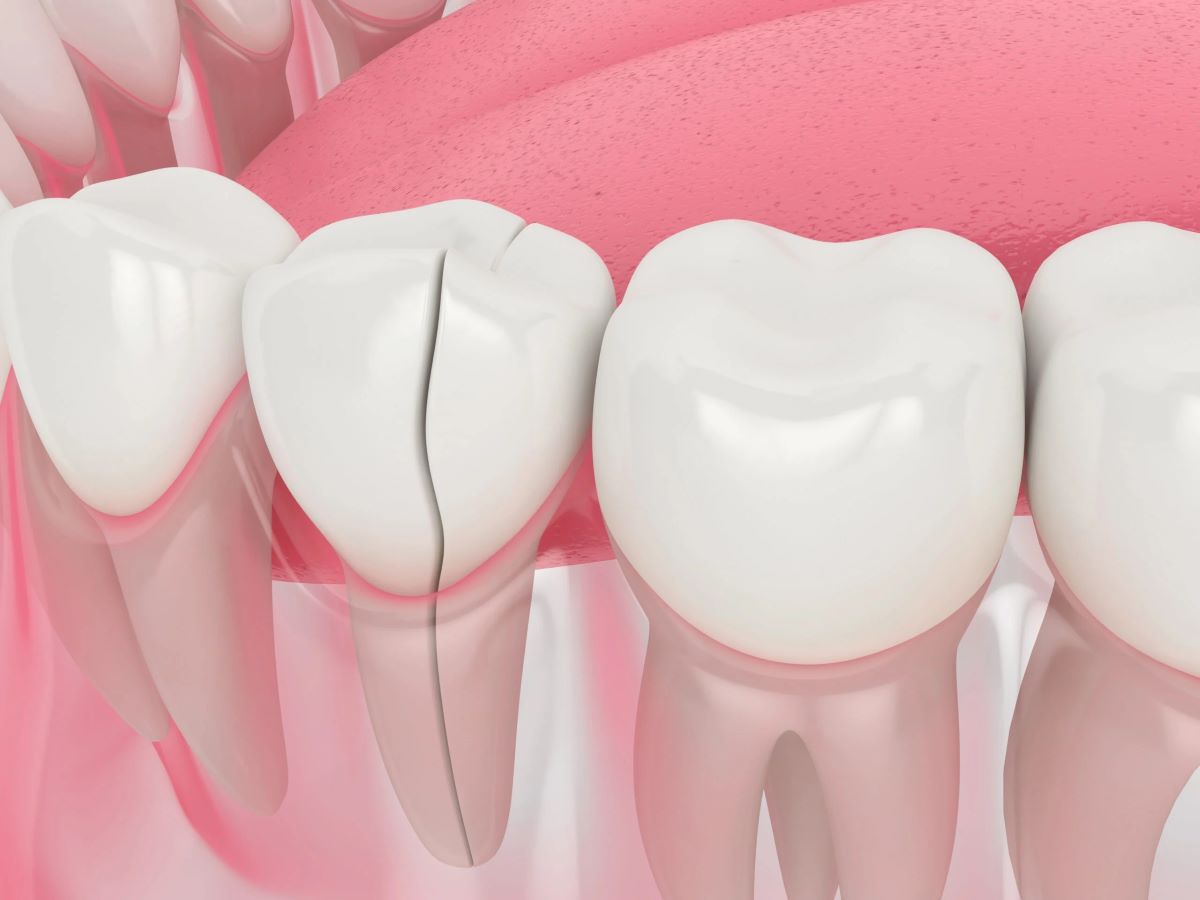 How Much Does It Cost To Fix A Broken Tooth Without Insurance?