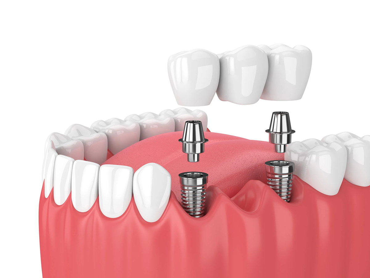 How Much Is A Dental Bridge Without Insurance