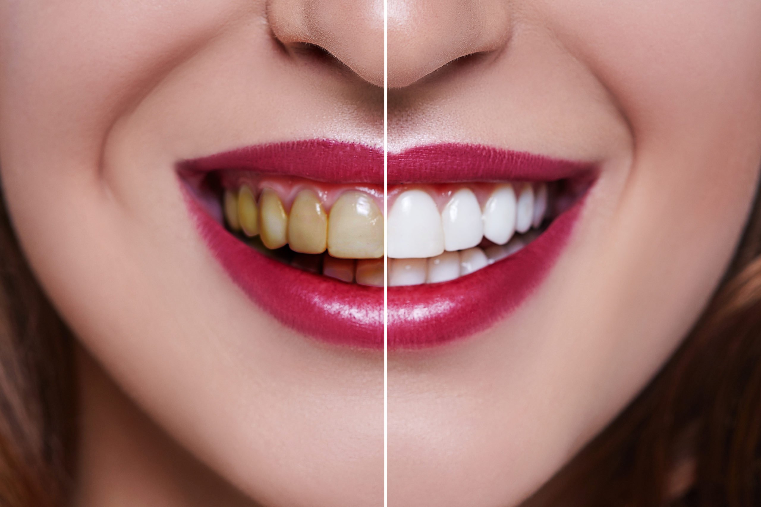 How Much Is A Full Set Of Veneers With Insurance?