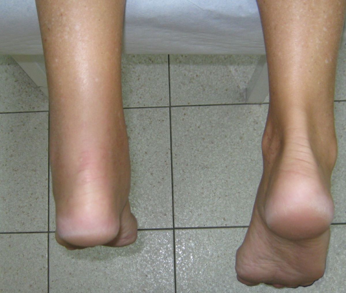 How Much Is Achilles Tendon Surgery With Insurance