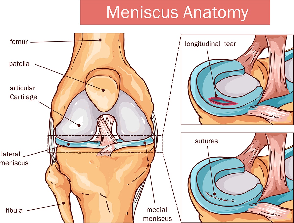 How Much Is Meniscus Surgery Without Insurance?
