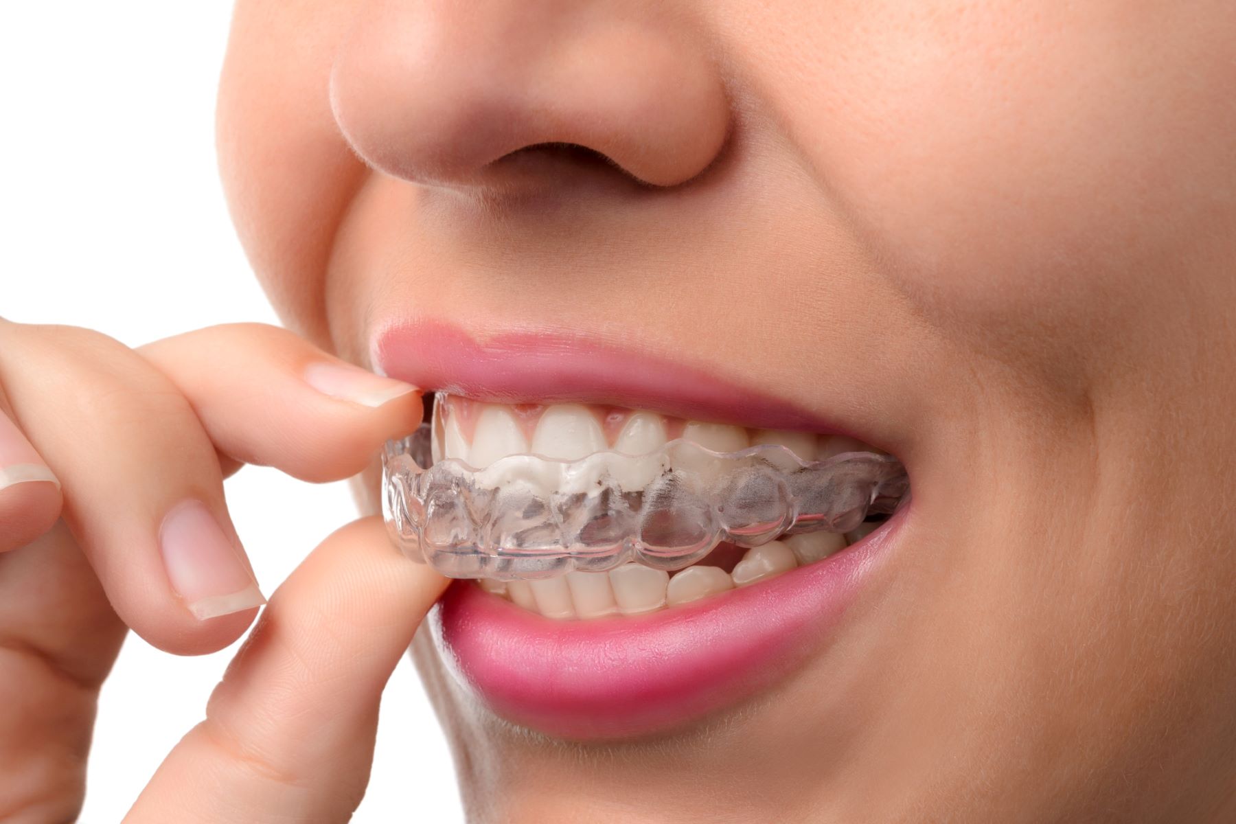 How To Get Invisalign Covered By Insurance