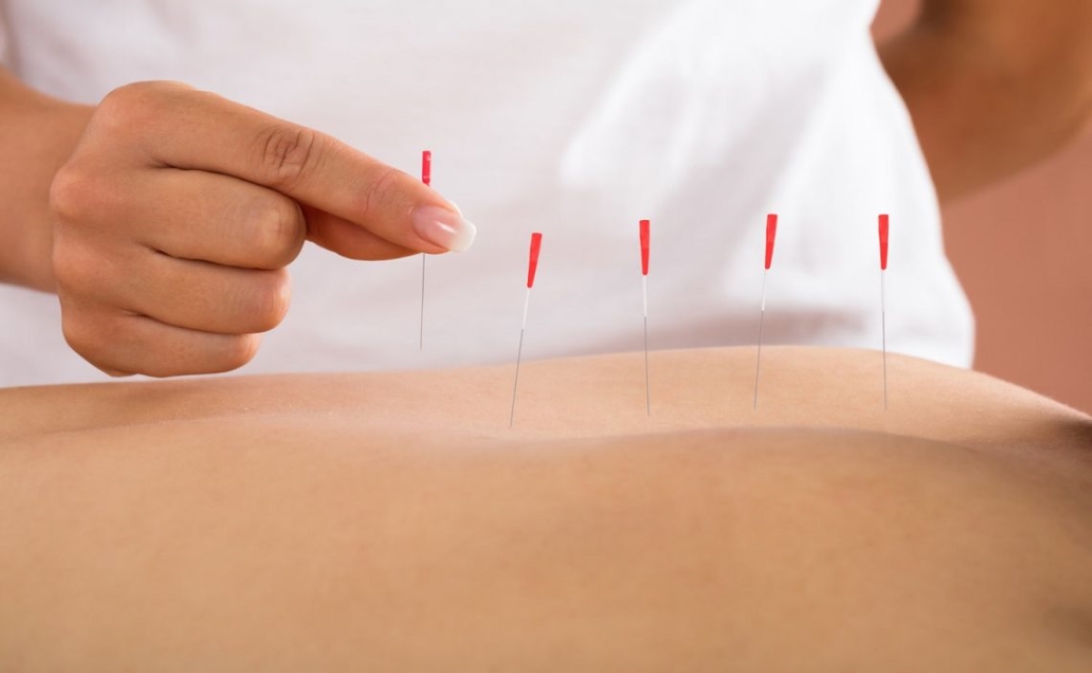 What Insurance Companies Cover Dry Needling?