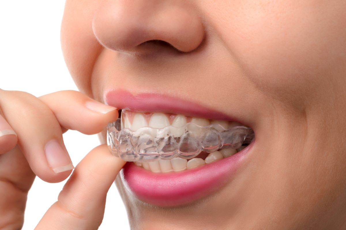 Which Insurance Covers Invisalign?