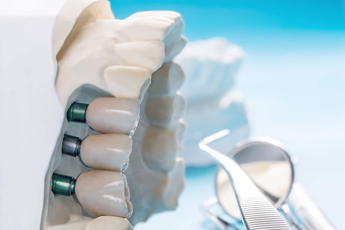 Why Doesn’t Dental Insurance Cover Implants?